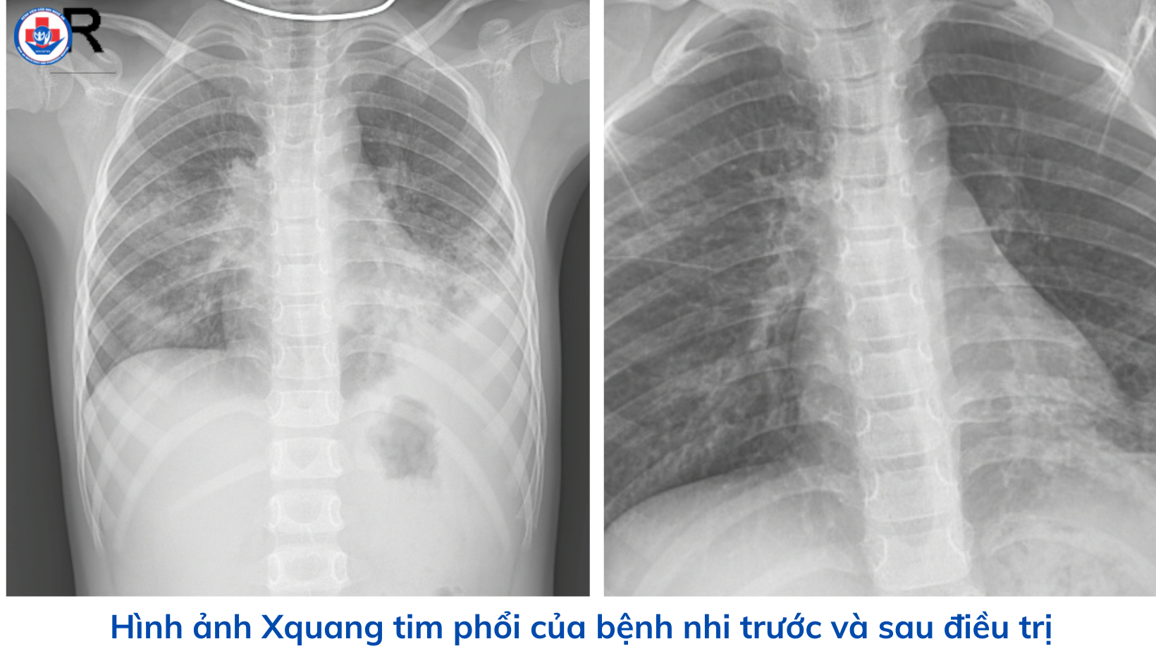 Viêm phổi do Mycoplasma – Bệnh nguy hiểm, cha mẹ không nên chủ ...