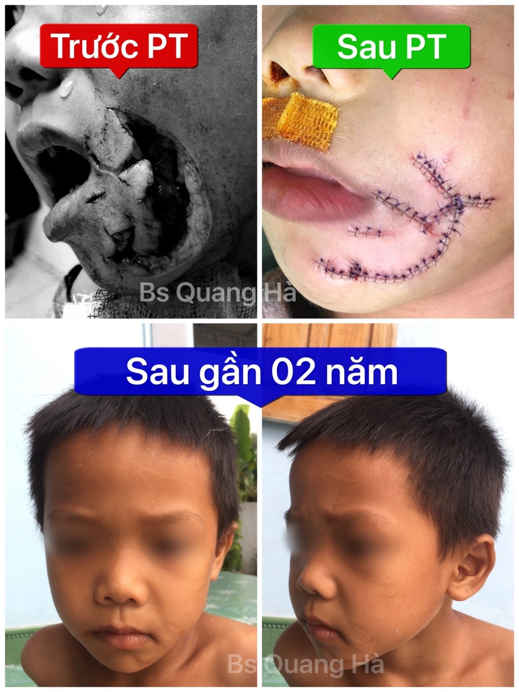 Làm gì khi bị chó cắn để không nguy hiểm đến tính mạng?