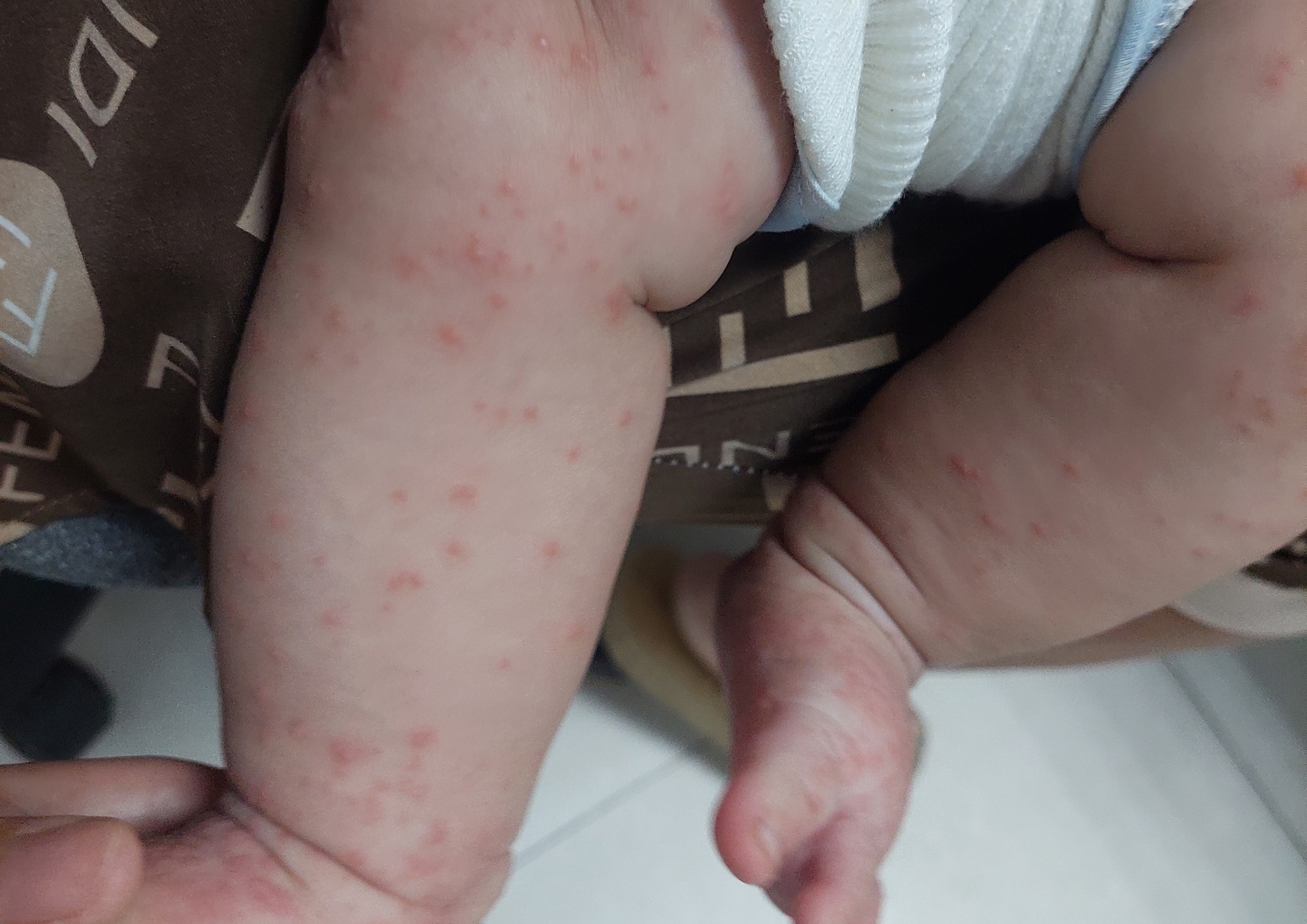 hình ảnh bệnh ghẻ ngứa